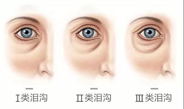 年老型泪沟依据衰老程度分为三类