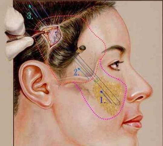 为什么做面部提升手术，医生建议你同时做面部吸脂？