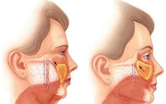 为什么做面部提升手术，医生建议你同时做面部吸脂？