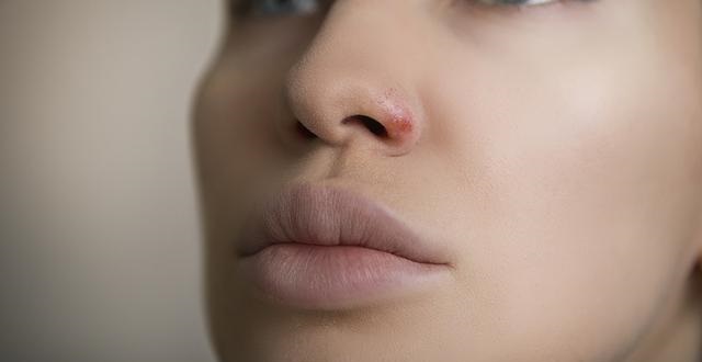驼峰鼻和阔鼻畸形如何通过手术矫正