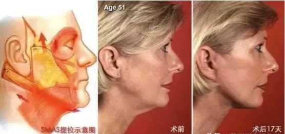 做了面部提升手术，为什么会出现不自然，甚至增龄的情况？