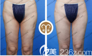 王东大腿吸脂修复案例对比图