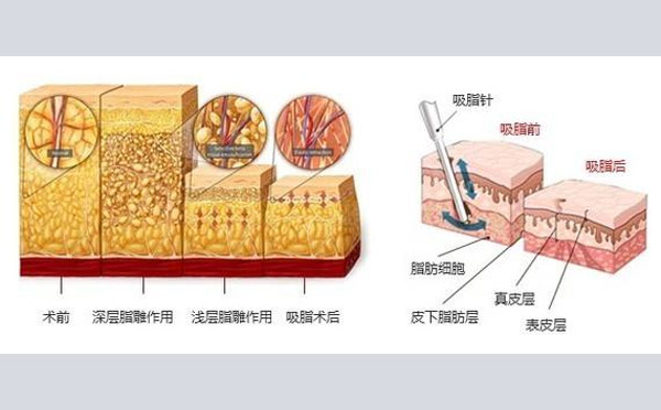 吸脂手术原理！