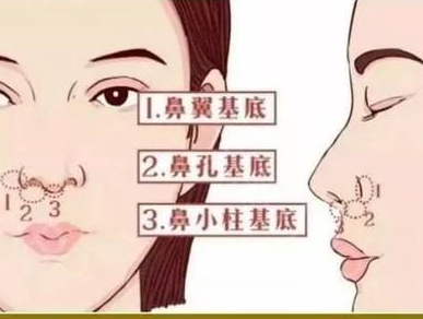 艺美王东：鼻型矫正也可以使用自体脂肪填充的方式