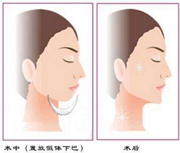 假体隆下巴通常是在口腔内做切口
