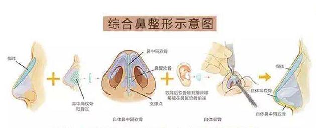 鼻综合手术原理介绍