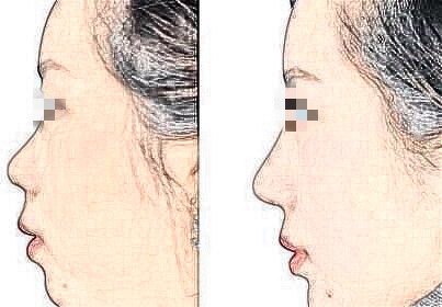 耳软骨隆鼻能维持多久？