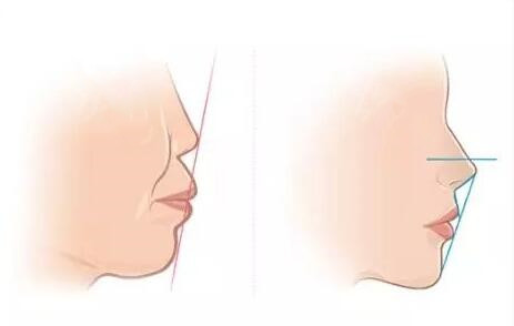 不同的鼻部问题适合不同的鼻部整形方法