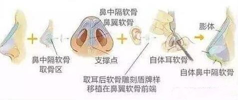 一般鼻整形和综合隆鼻的差别