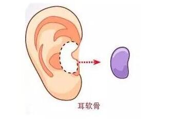 取耳软骨对耳朵有很大的伤害吗?