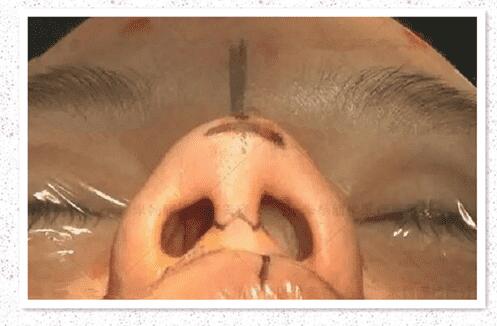 普遍鼻部整形手术难题解析