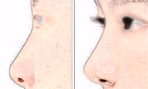 做假体隆鼻的效果明显吗?