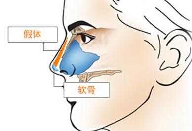 鼻中隔隆鼻手术会有什么后遗症呢?