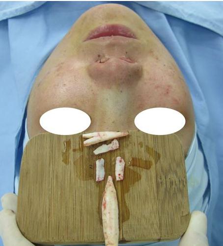 肋软骨隆鼻手术是如何操作的?
