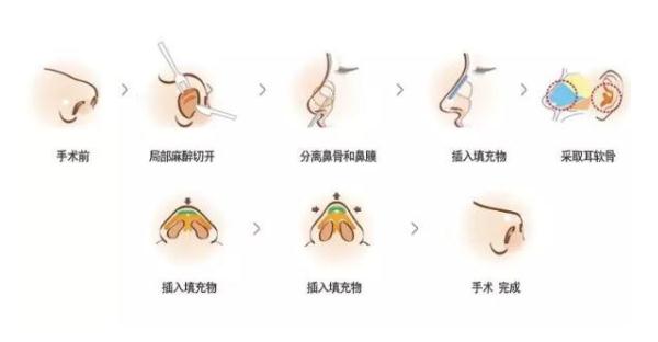 假体耳软骨隆鼻怎么做？手术步骤图解！