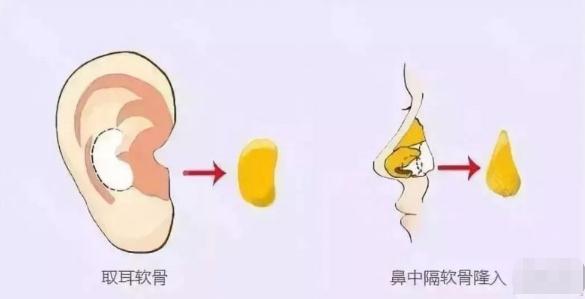 假体耳软骨隆鼻怎么做?